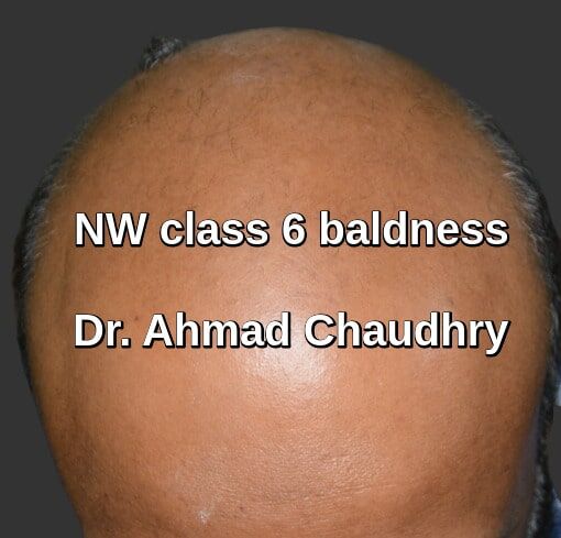 Hair transplant Sargodha patient | 2535...