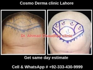 Surgical methods role in hair loss...