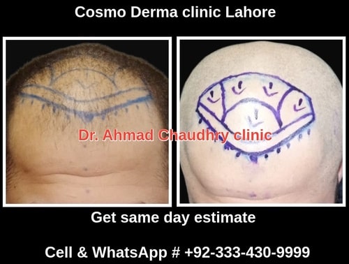 Surgical methods role in hair loss...