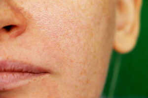 Open pores on the face, get...