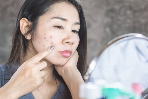 How to Get rid Of Dark...